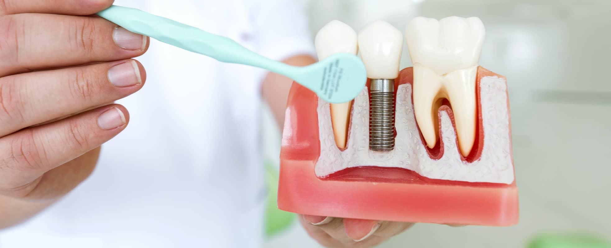 Tout savoir sur la pose d’implant dentaire | Dr Elhyani | Paris